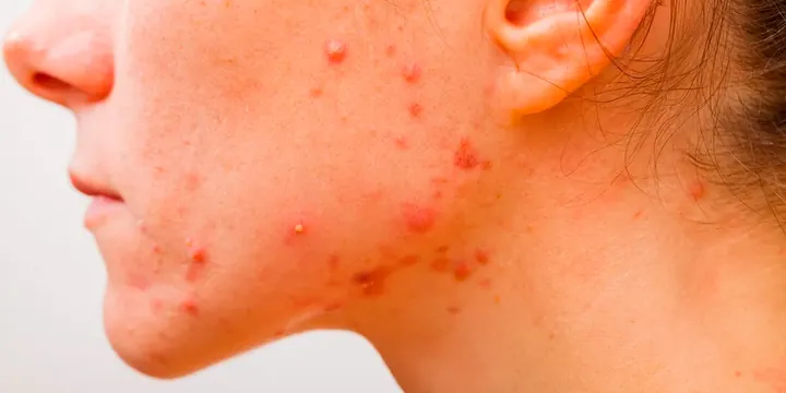 Pele com acne