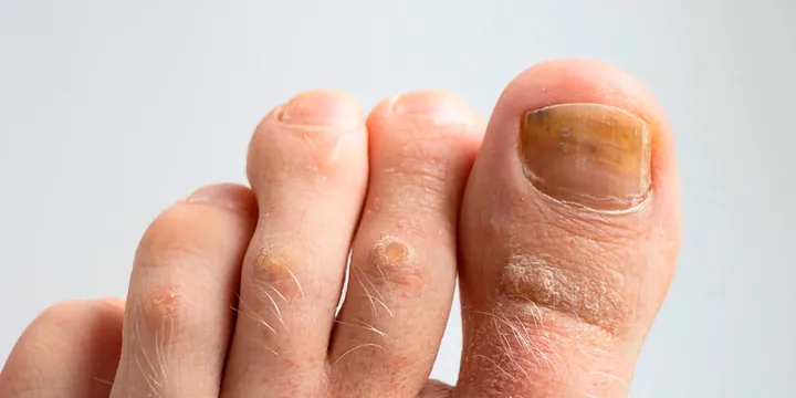 Micose nas unhas
